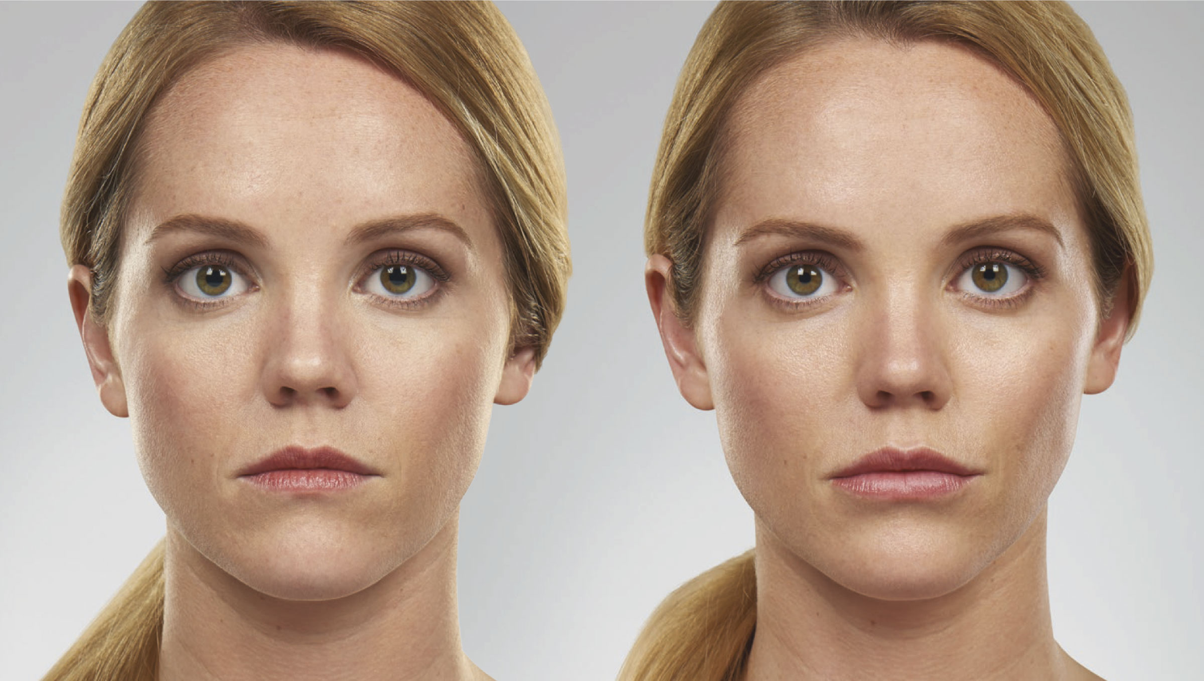 Филлер Juvederm Voluma