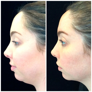 Kybella-before-and-after-images-1