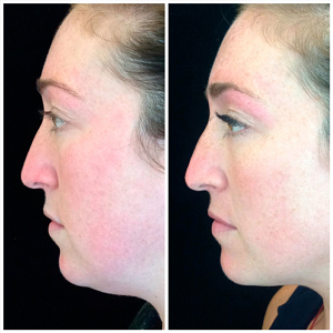 Kybella-before-and-after-images-2