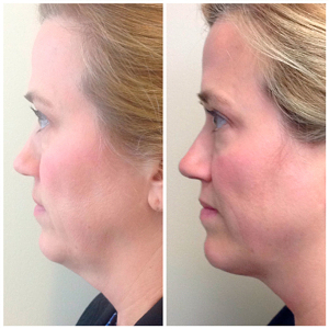 Kybella-before-and-after-images-3