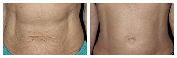 🌟THERMAGE FLX TUMMY TIGHTENING BEFORE 🆚AFTER 🌟Perfect for saggy stomach  skin.🌟 Thermage®️FLX system uses non-invasive rad